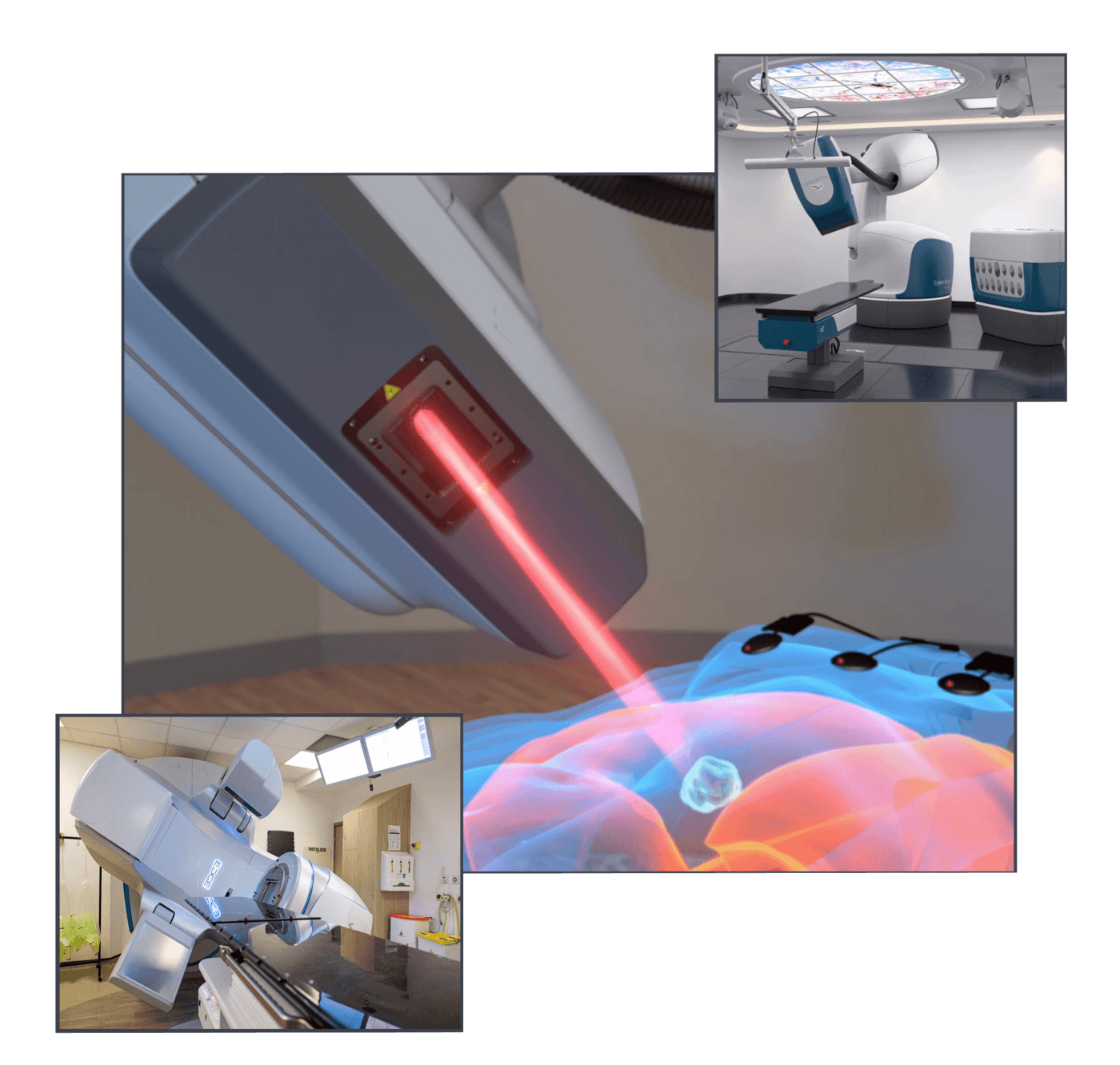 Radiotherapy That Targets Cancer With Millimetre Accuracy