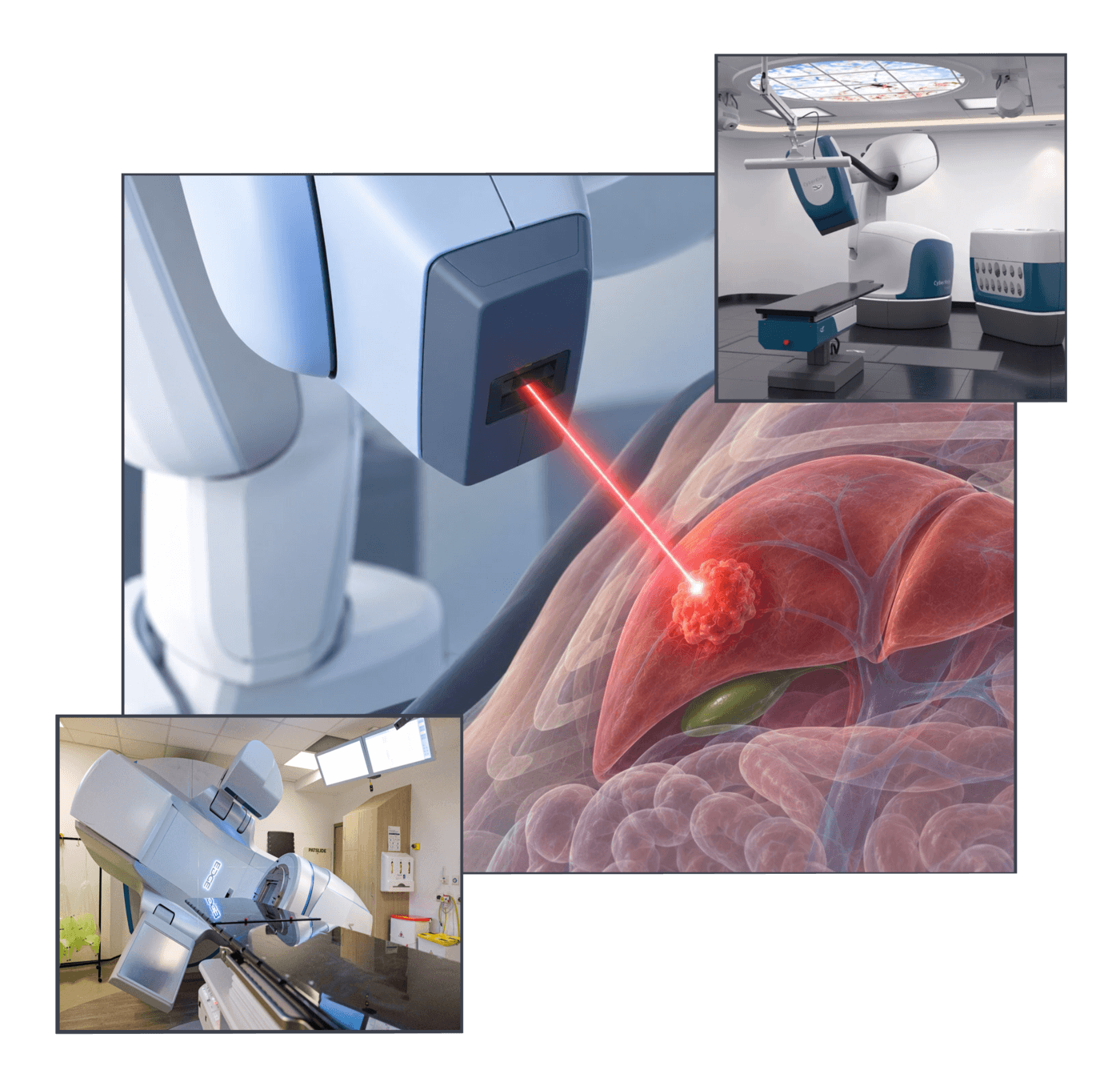 What Is Sabr Treatment For Liver Cancer