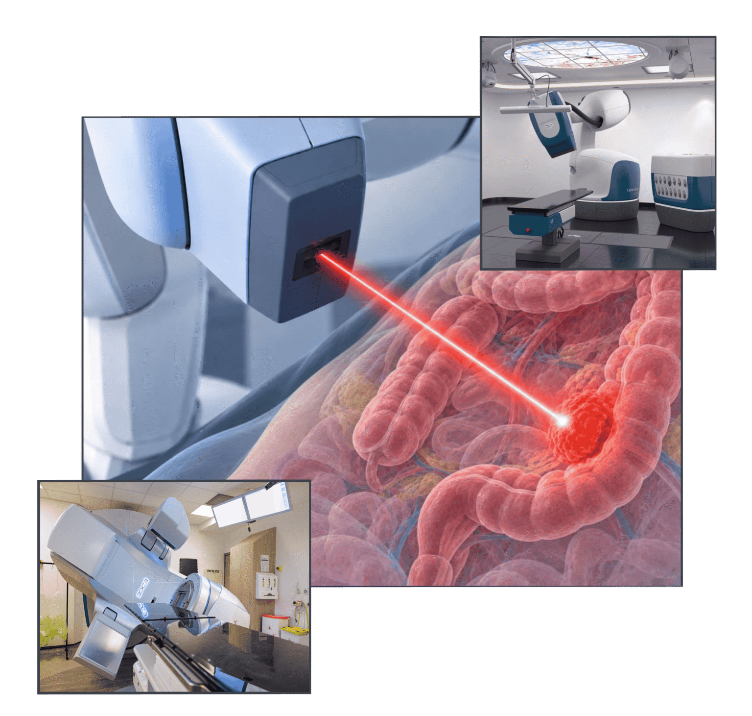 SABR for colon cancer