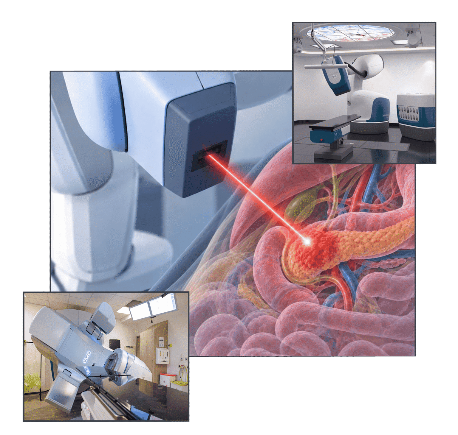 SABR TREATMENT FOR PANCREATIC CANCER