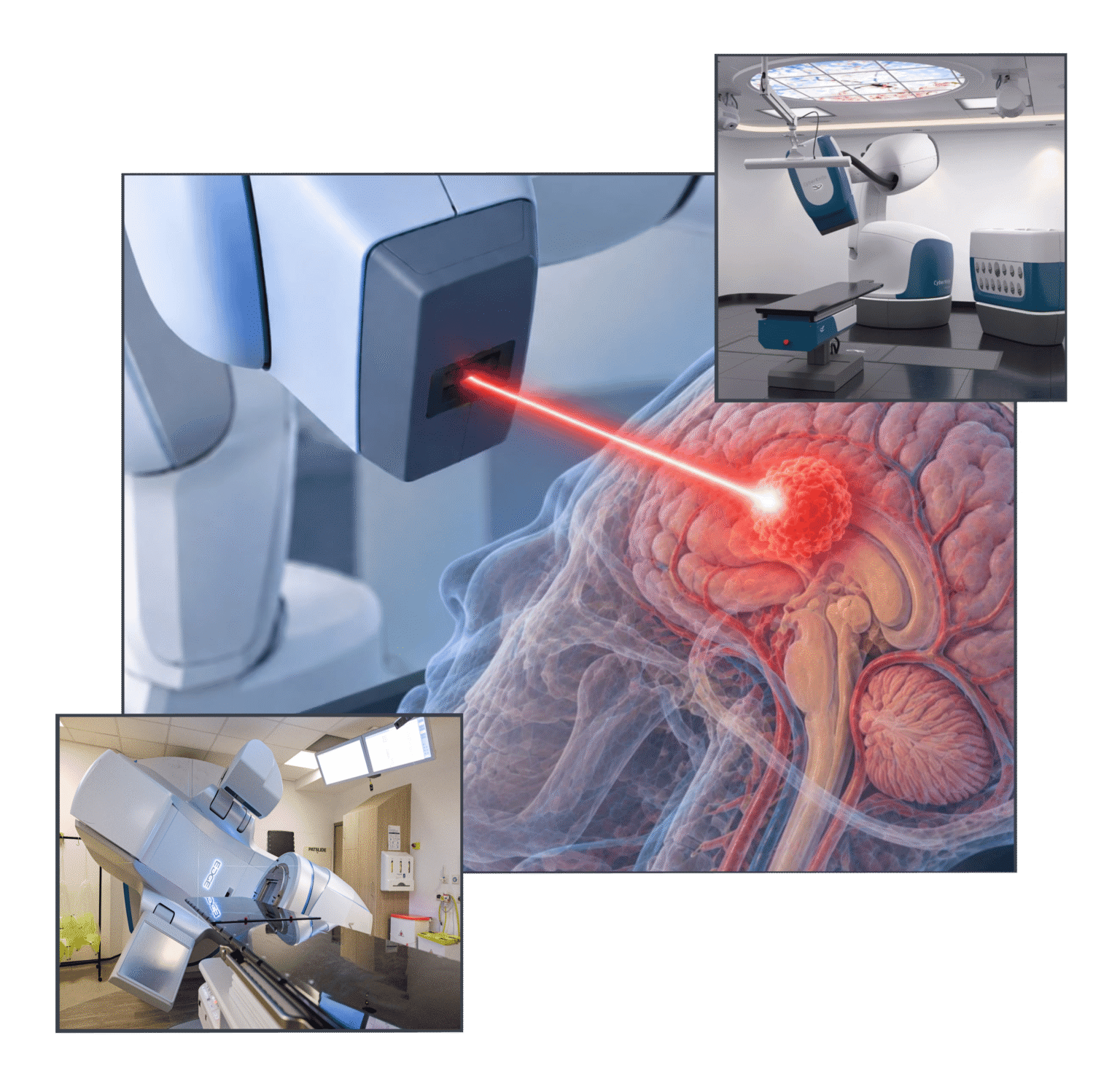 SABR FOR BRAIN METASTASES