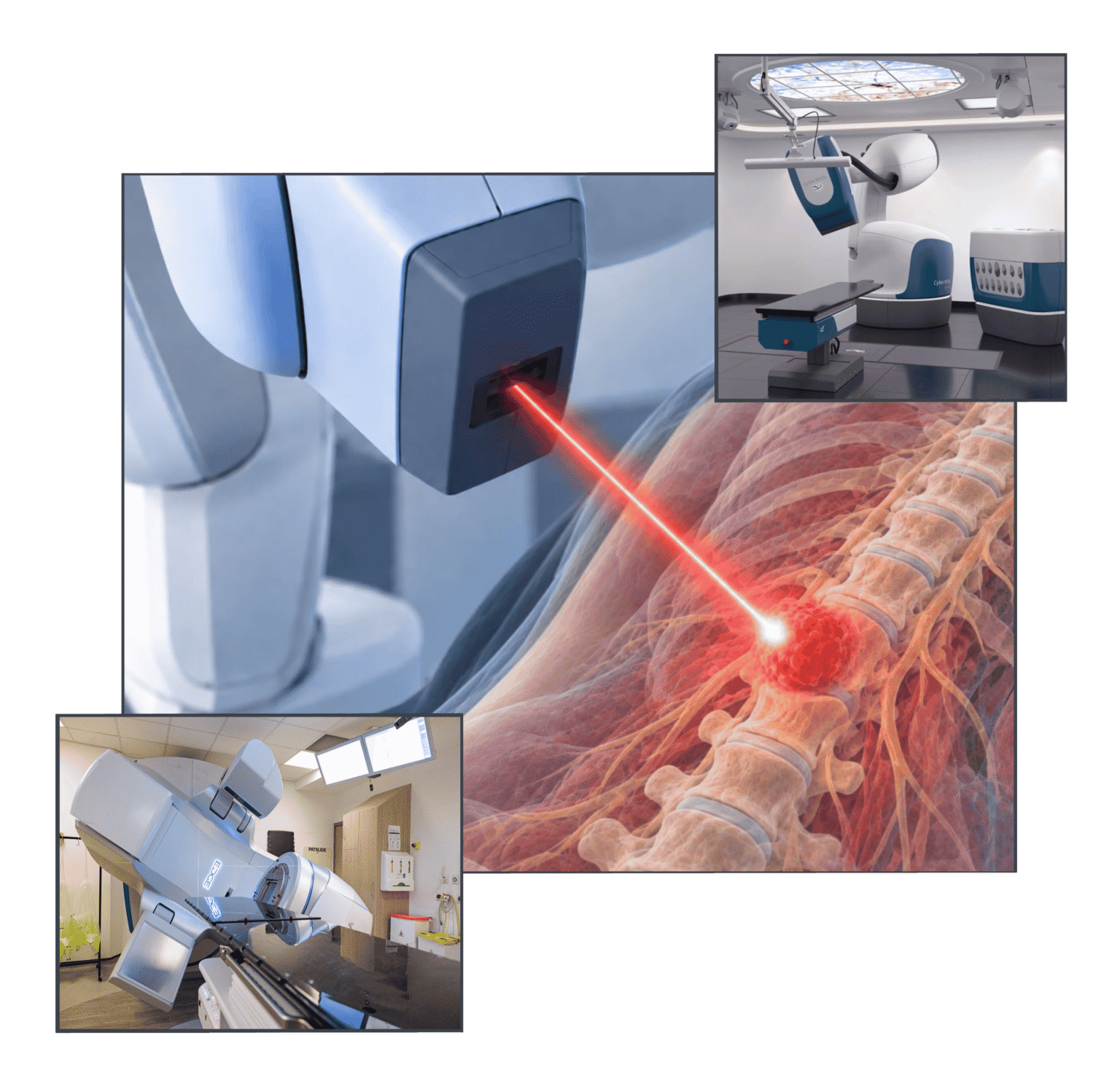 SABR for spine metastases